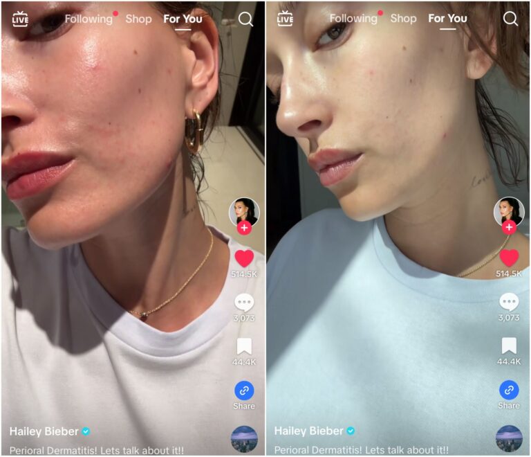 Hailey Bieber Shared Her 3-Step Skin Care Routine During a Perioral Dermatitis Flare Up